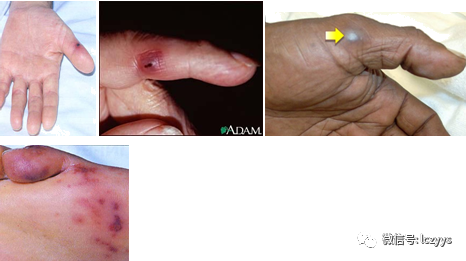 出血瘀点janeway损害roth斑osler结节指(趾)甲下线状出血瘀点周围体征