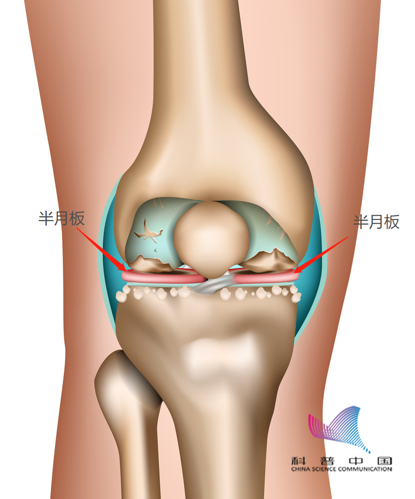 半月板这么脆弱 出现这些症状千万别大意 腾讯新闻