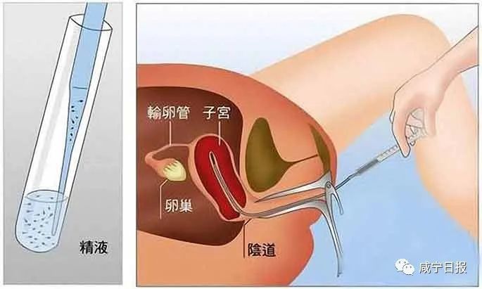 男性因素 1,輕度或中度的少精,弱精,畸精 2,精液不液化或液化不良 4