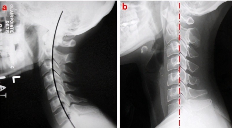 颈椎曲度变直,反屈",在颈椎过伸位,过屈位片子上可以看到颈椎相邻椎体