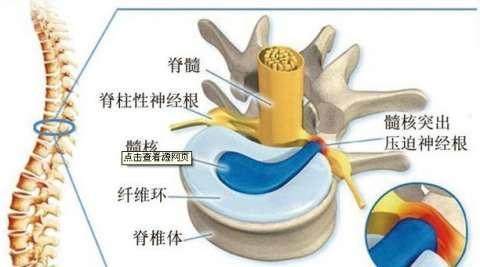 延安椎间盘突出邱悬壶图片