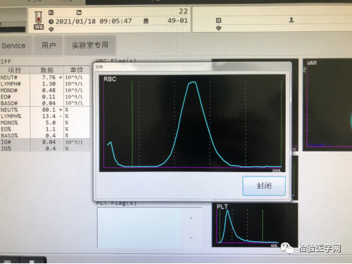 巨幼细胞性贫血|层层推理，一步步揭开你的面纱！
