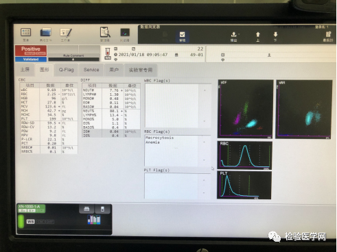 巨幼细胞性贫血|层层推理，一步步揭开你的面纱！