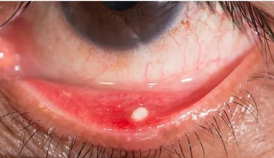 眼睛总觉得磨或许是长结石了