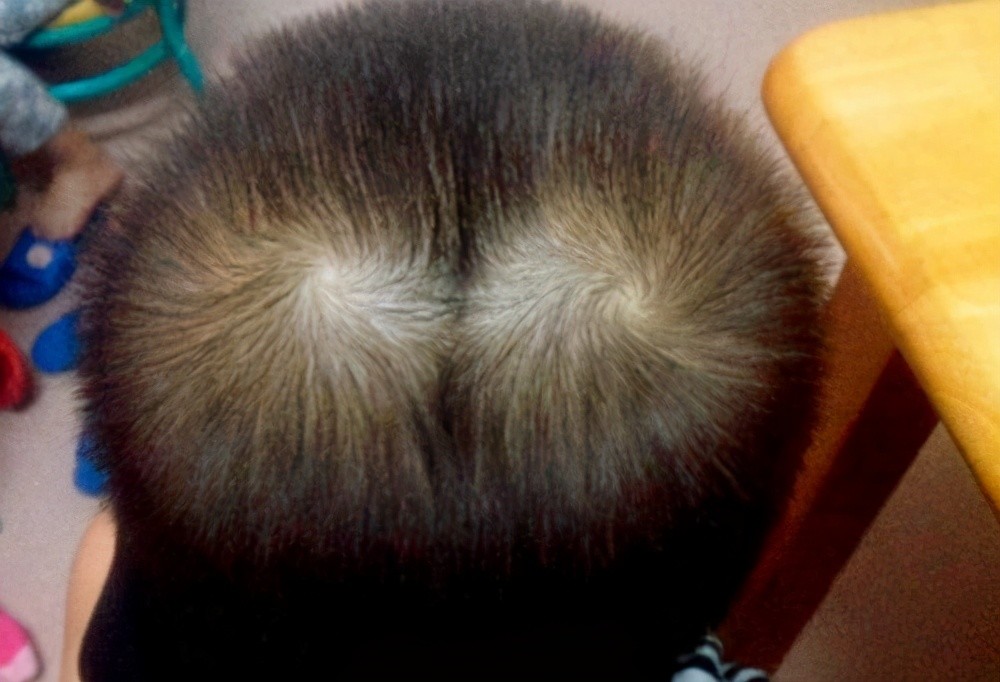 为什么有的孩子头上有2个旋?代表什么