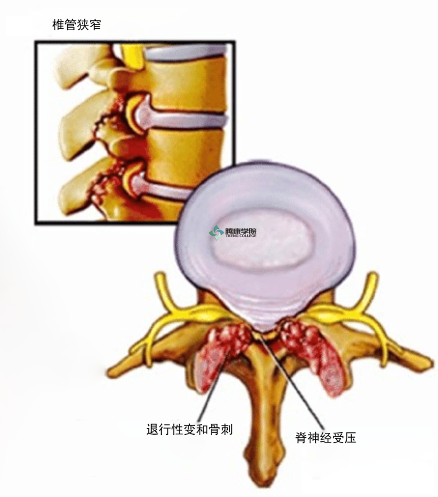 腰椎间盘突出症那些事儿 腾讯新闻