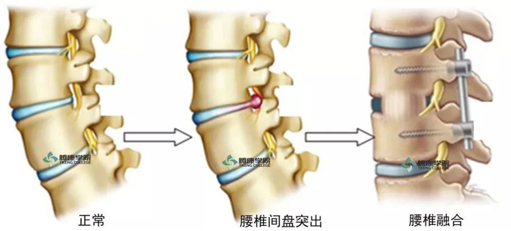 腰椎間盤突出症那些事兒