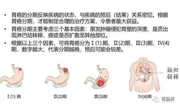 85是中晚期难道胃癌来临就没有任何征兆