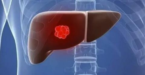 转氨酶|体检报告单中“转氨酶”偏高，意味着什么？看看医生怎么说