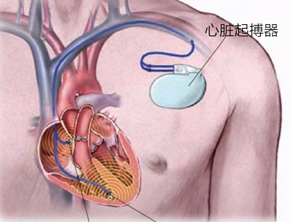 心動過緩患者你瞭解心臟起搏器嗎