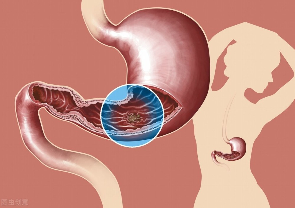 胃溃疡|谁在你的胃里“打洞”？胃溃疡的4大“夺命”并发症，千万别大意