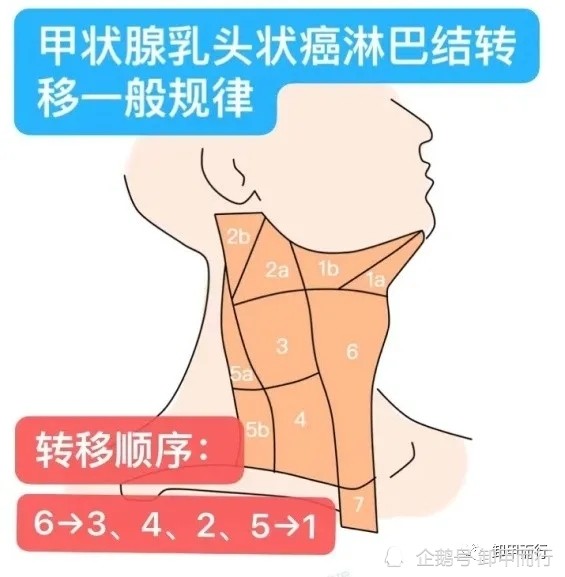 20%到90%的分化型甲狀腺癌患者,在確診時即存在頸部淋巴結轉移,以