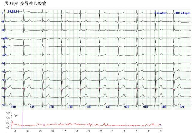 教你看懂心肌缺血發作時的心電圖表現_騰訊新聞