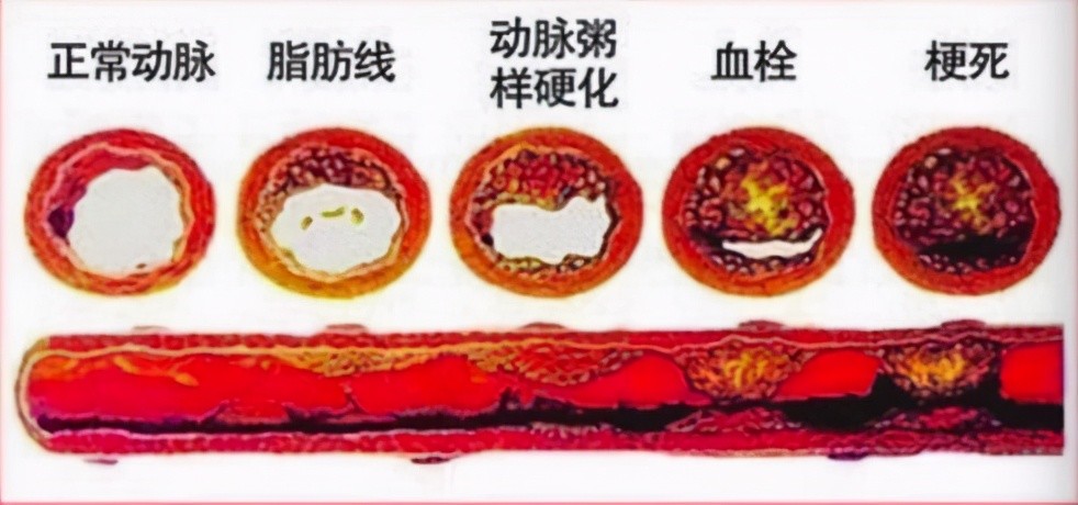 不想去医院如何能知道自己的血管有没有动脉粥样硬化