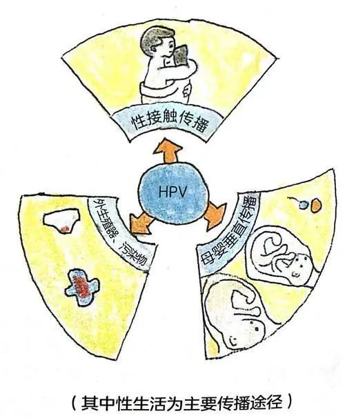 宫颈tct和hpv两者结合检测更准确