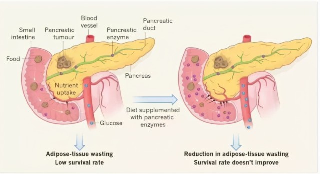 脂肪堆積在胰腺,引發胰腺發生病變,這種病就是—— 脂肪胰,很多人忽略