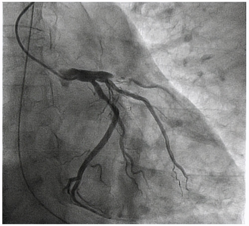 行冠状动脉造影一看,所有人都惊出一身冷汗:心脏的两根重要血管完全