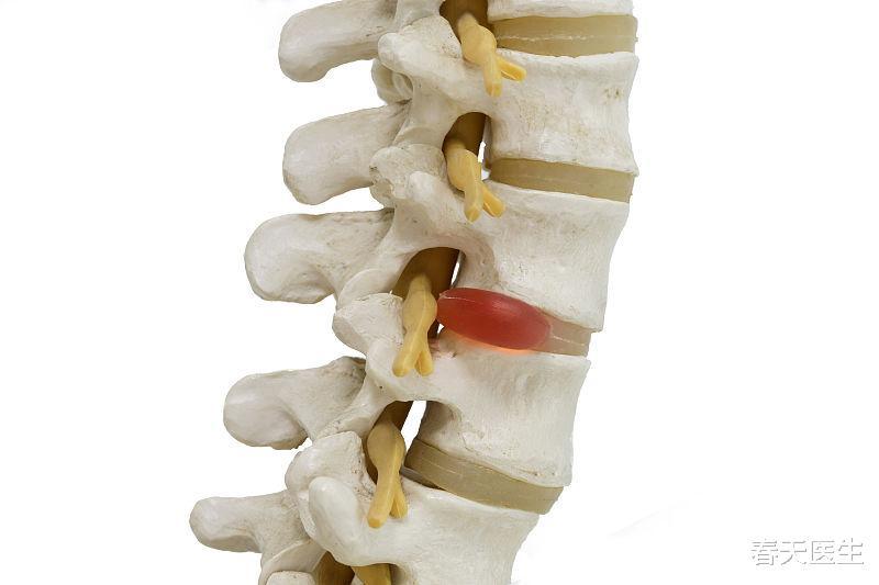 关于腰椎椎间盘突出与保守性治疗,一文看懂,不再走弯路_腾讯新闻