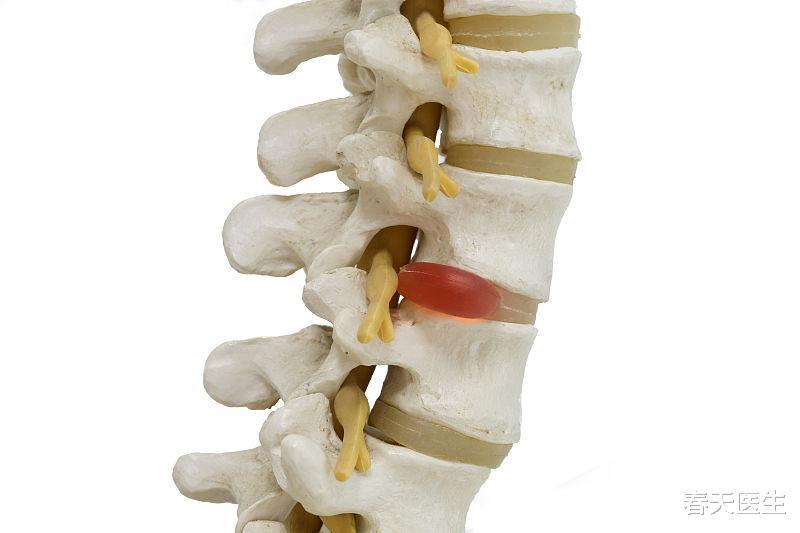 關於腰椎椎間盤突出與保守性治療,一文看懂,不再走彎路_騰訊新聞