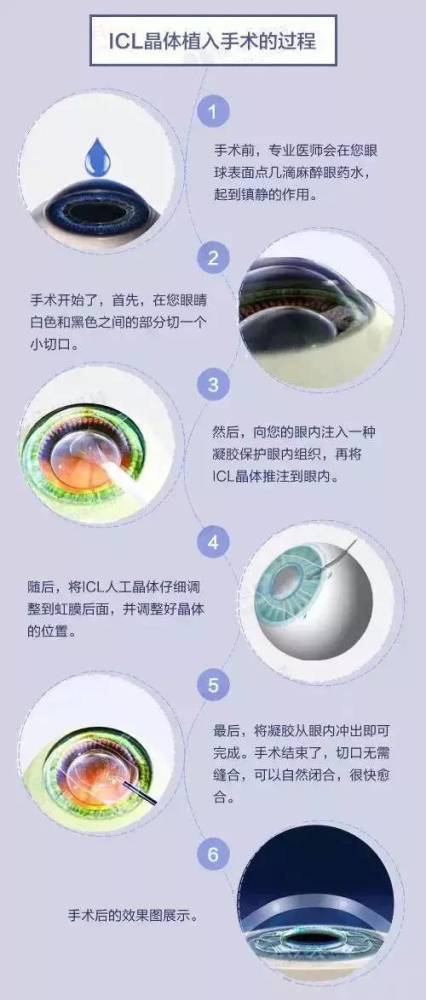 近视手术|近视800度如何选择近视手术方式？其实不难！