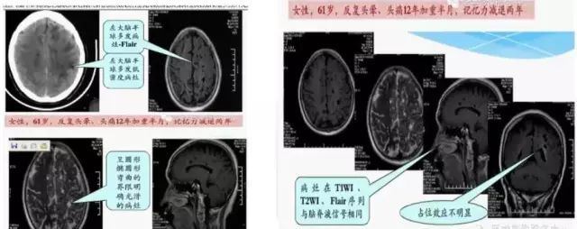 腔隙性脑梗死|【提醒】腔隙性脑梗死诊疗中的9大雷区