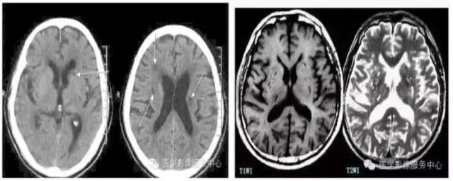 腔隙性脑梗死|【提醒】腔隙性脑梗死诊疗中的9大雷区