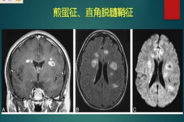 腔隙性脑梗死|【提醒】腔隙性脑梗死诊疗中的9大雷区