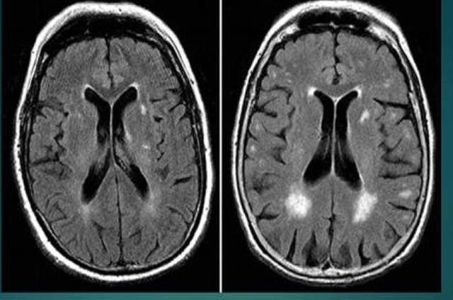 腔隙性脑梗死|【提醒】腔隙性脑梗死诊疗中的9大雷区