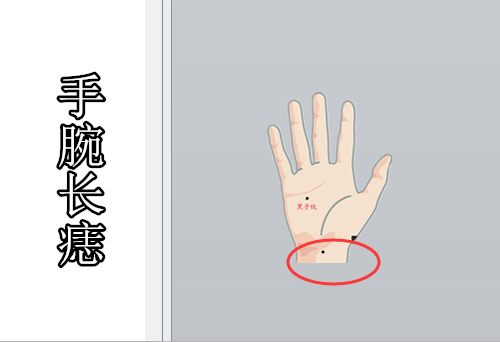 手腕长痣