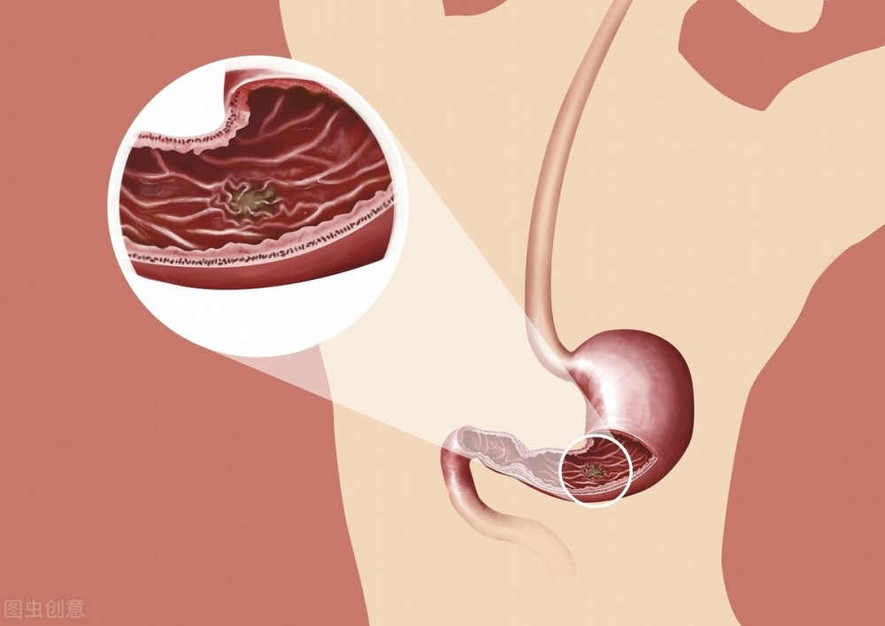 胃溃疡|胃溃疡不痛就没事？提醒：这4类人，需警惕无痛性溃疡，远离癌变
