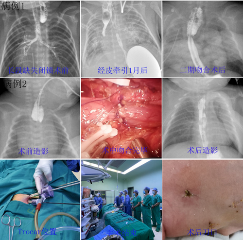 体重3斤的早产儿先天食管闭锁,外科微创手术成功救治_腾讯新闻