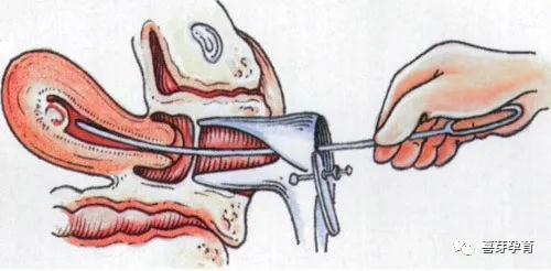 宫颈水囊图片