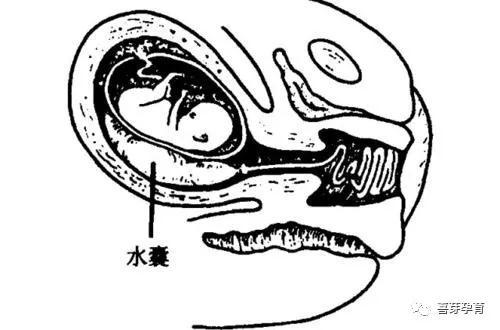 水囊引产的禁忌症有:●慢性炎症,如阴道炎,疱疹病毒感染,重度宫颈糜烂