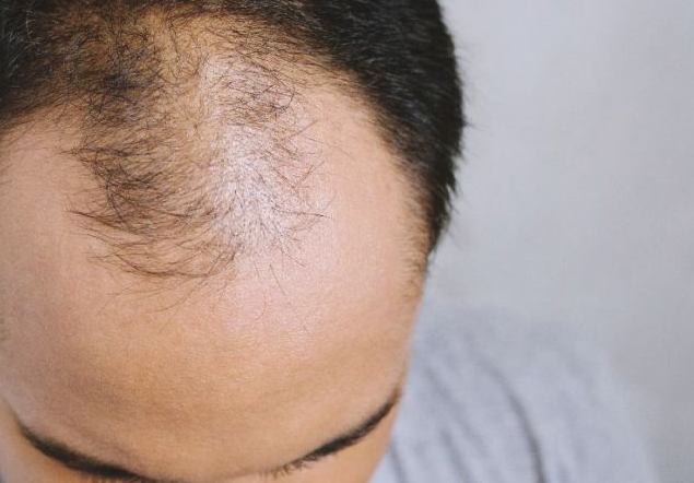 15岁少年秃头又掉发同学家长怒检举他绝对有40岁了