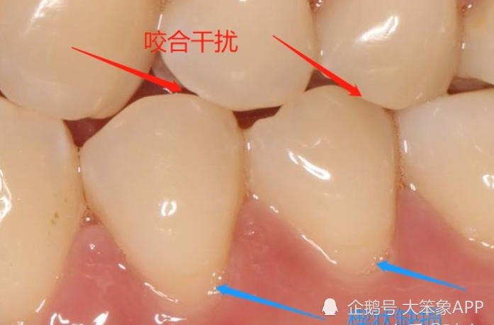 在每天巨大的咬合力作用下,異常位置的牙齒不是