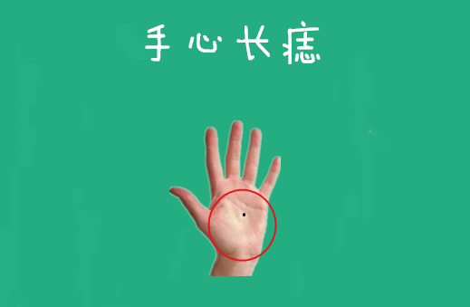 手心长痣