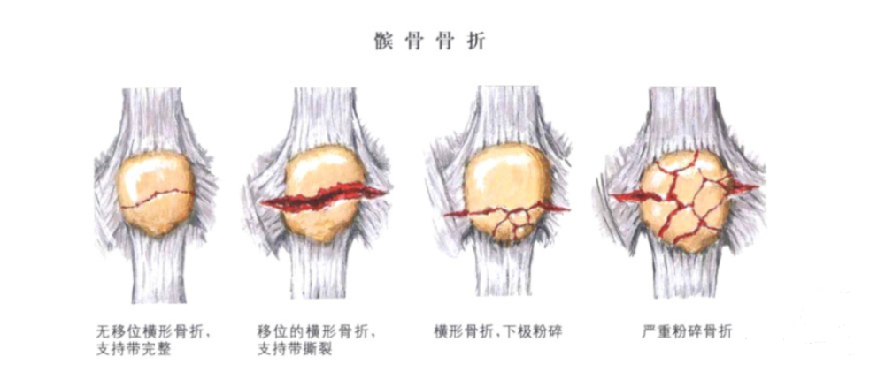 髌骨解剖及髌骨病变影像学表现