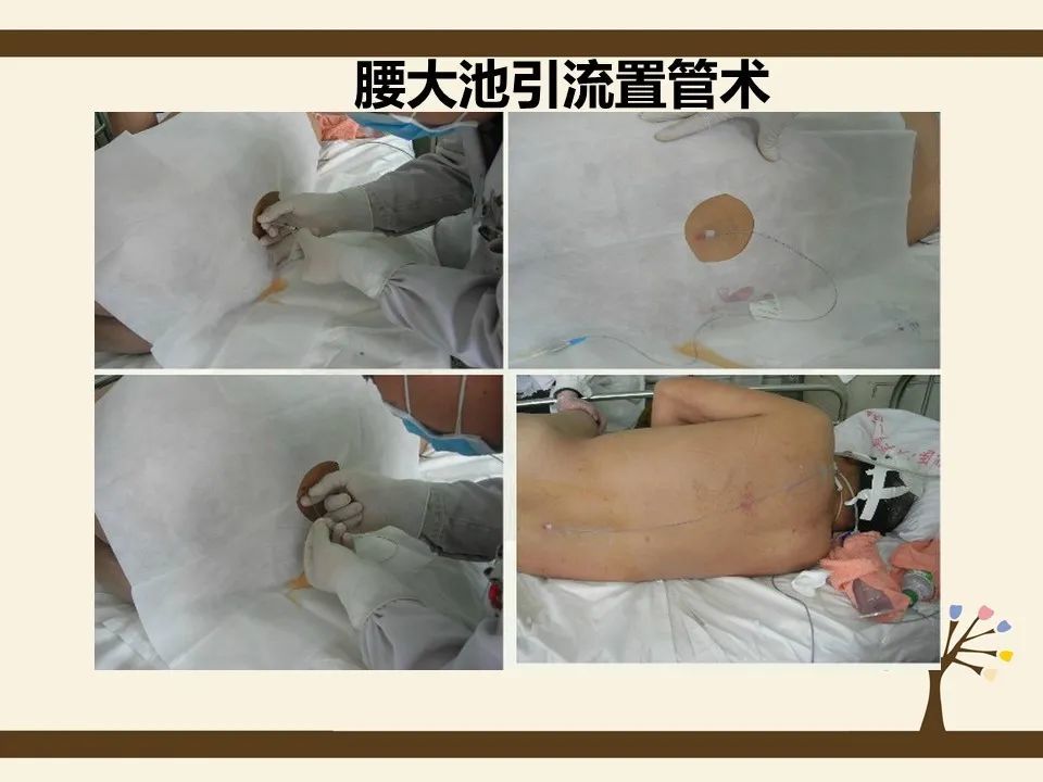 ppt腰大池引流的护理