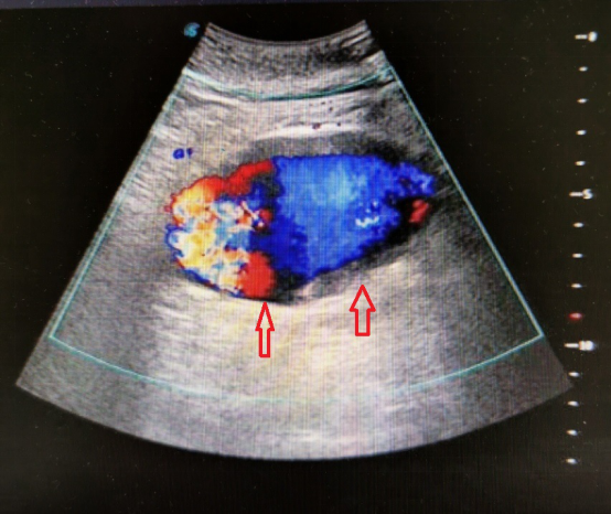 超声医生检查时多看一眼发现凶险的腹主动脉瘤