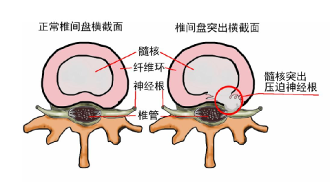 腰间盘突出的原理图解图片