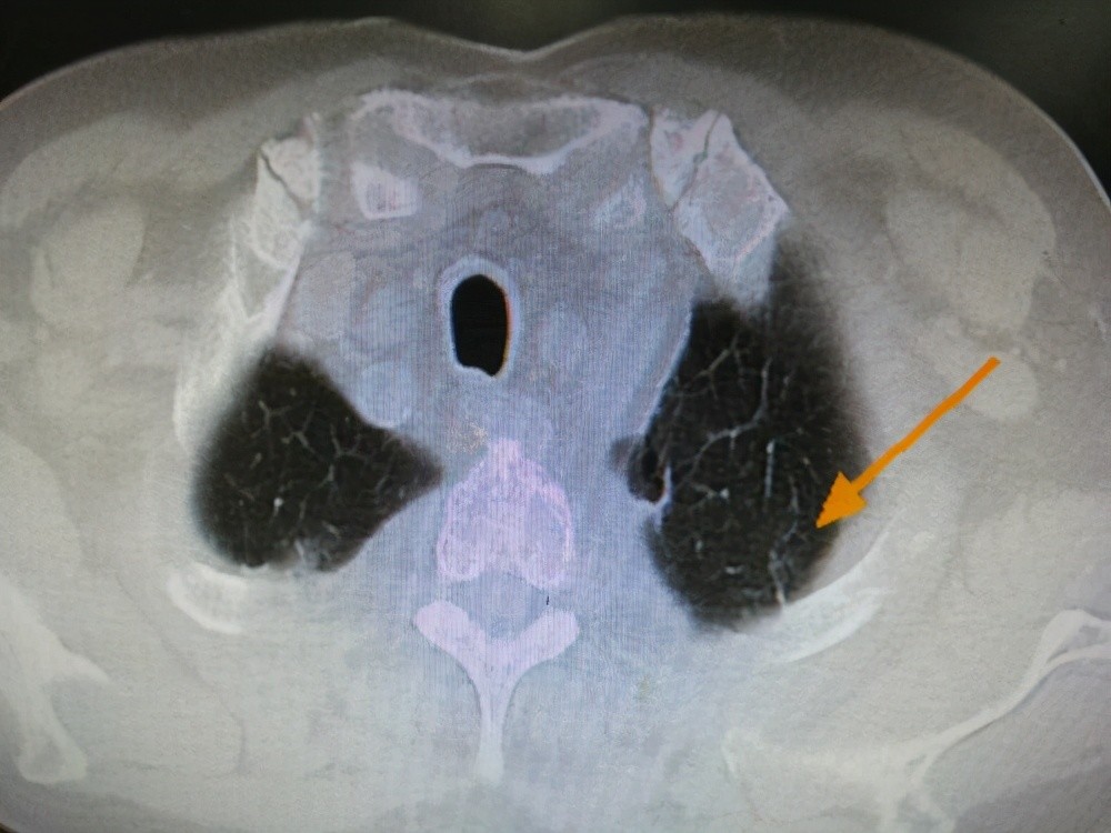 肺部|哪些肺部影像报告不必太在意？看门诊医生看一眼就会打发你