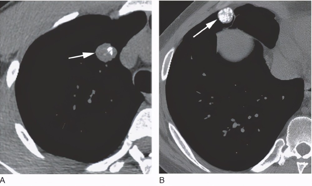肺部|哪些肺部影像报告不必太在意？看门诊医生看一眼就会打发你