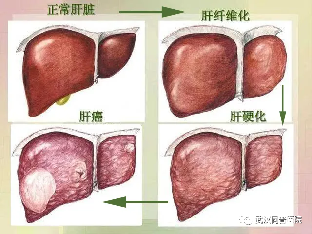 武汉同普肝病医院潘运华解答29岁小伙查出肝纤维化还有机会逆转吗