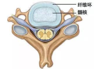 腰椎间盘突出|腰椎间盘突出、膨出、脱出傻傻分不清？一次给你解答清楚！