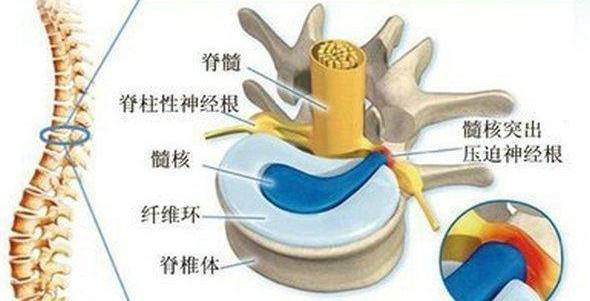 腰椎间盘突出|腰椎间盘突出、膨出、脱出傻傻分不清？一次给你解答清楚！