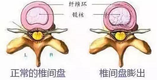 腰椎间盘突出|腰椎间盘突出、膨出、脱出傻傻分不清？一次给你解答清楚！