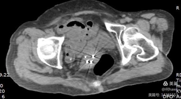 宫颈癌mdt团队经过详细讨论后,决定手术由宫颈癌外科专家团队和ct介入