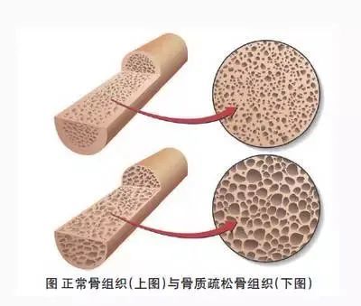 全身性的骨量减少及骨组织结构改变,骨单位密度变得稀疏而脆性增大