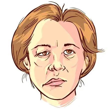 面肌痉挛13年,微创手术解忧烦