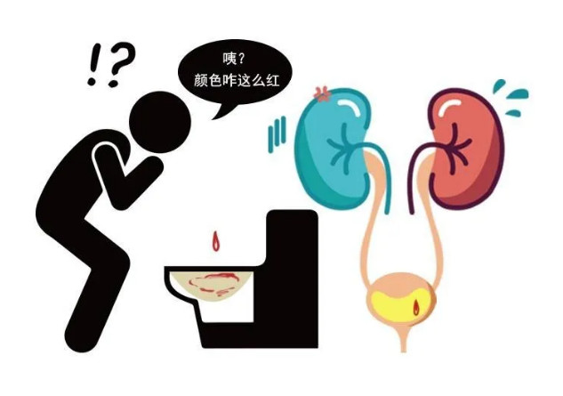 膀胱癌|羞答答的膀胱,静悄悄变"癌"